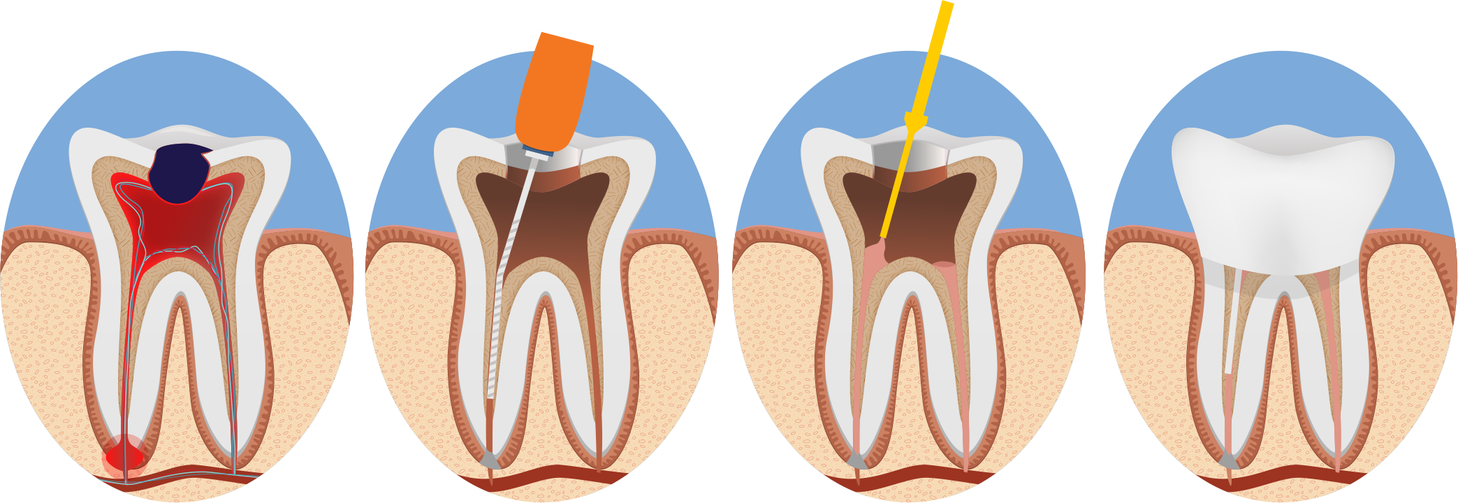 inspire root canal illustration